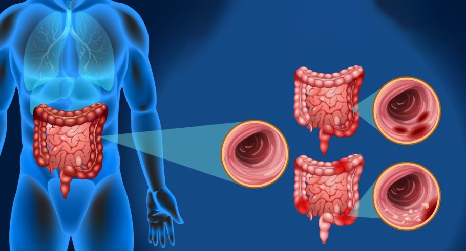 5 tipičnih simptoma koji mogu ukazati na ozbiljnu bolest creva